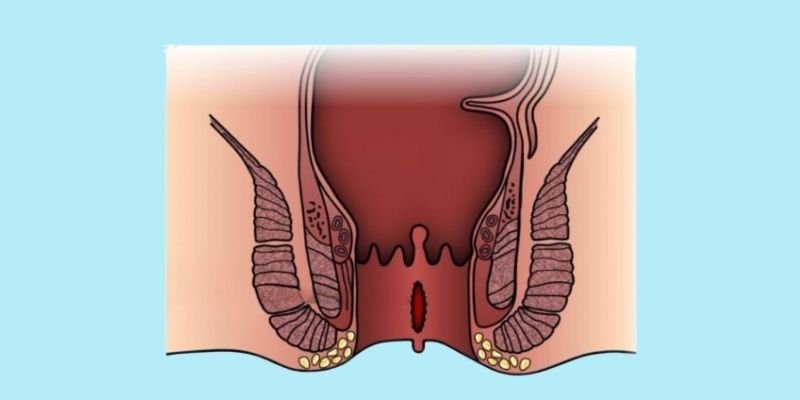 Laser Surgery for Anal Fissure
