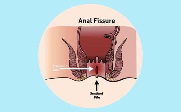 Laser surgery as a treatment for hemorrhoids