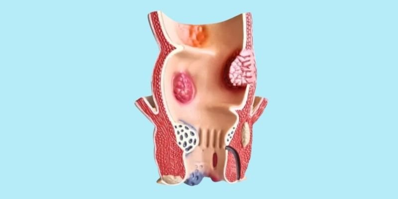 Anal Fistula Treatment