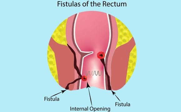 Diagnosis of Anal Fistula