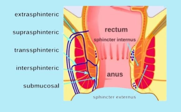 Anal Fistula