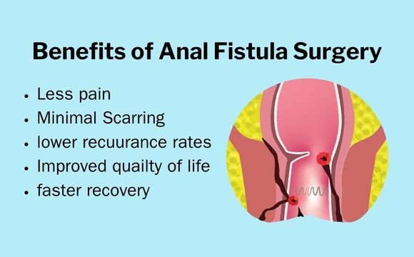 Benefits of Modern Fistula Surgery