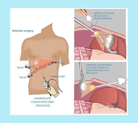 What is Laparoscopic Gall Bladder Surgery?