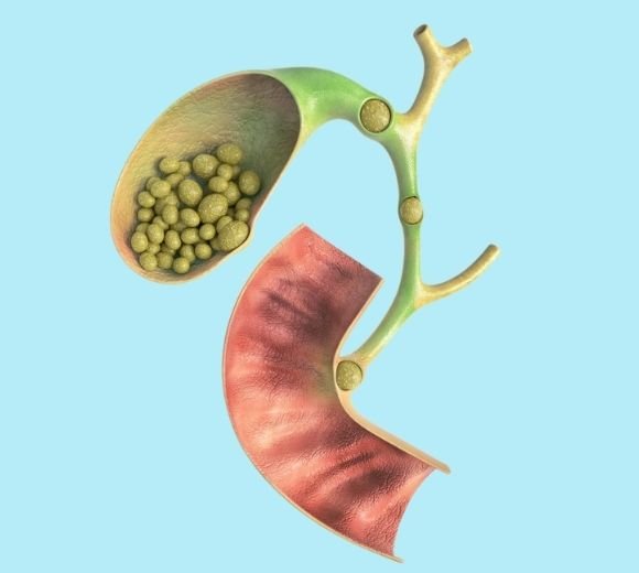 Candidate for Laparoscopic Gall Bladder Surgery?