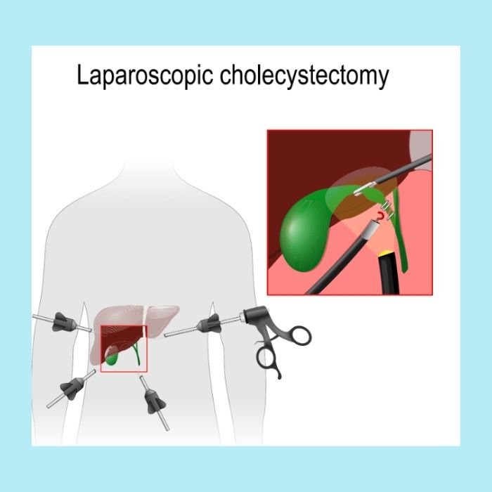Benefits of Laparoscopic Gall Bladder Surgery