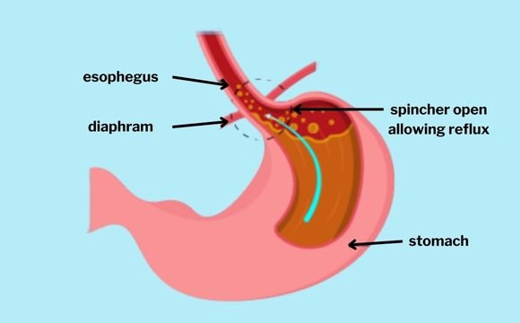 Common types of  anti-reflux surgery