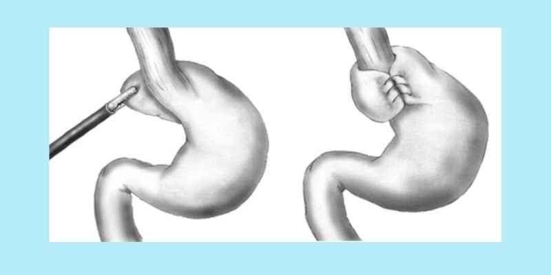 Laparoscopic GERD Surgery
