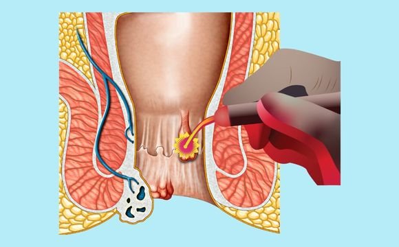 Laser Surgery for Hemorrhoids