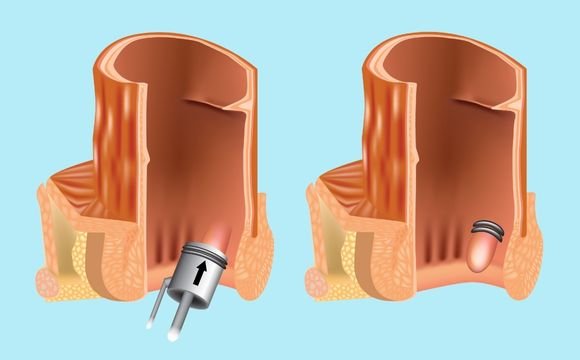 Ligasure Hemorrhoid Surgery