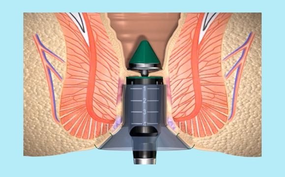 Stapler Hemorrhoidectomy