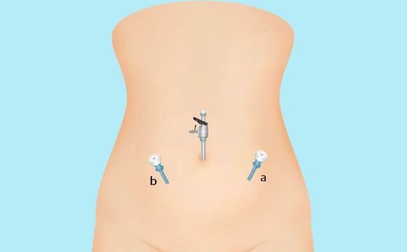 Ventral Hernia Surgery
