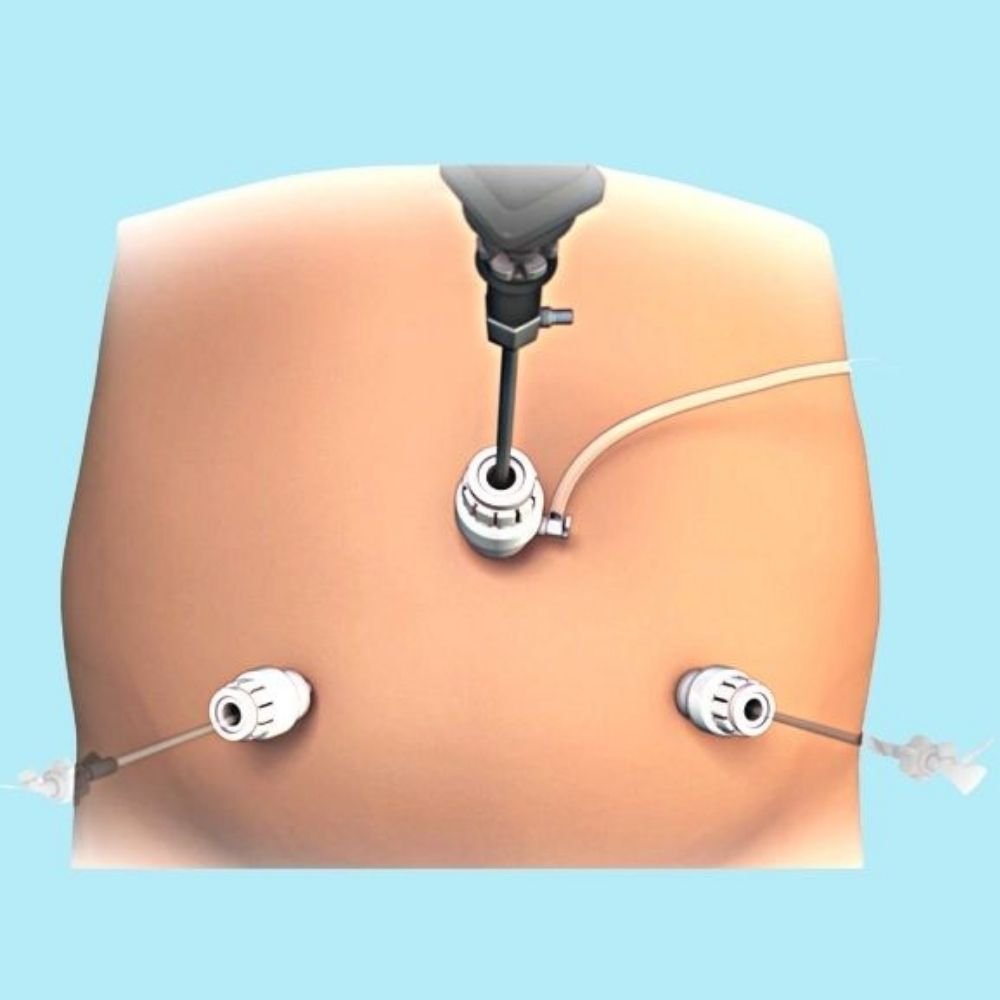 Benefits of Laparoscopic Ventral hernia treatment