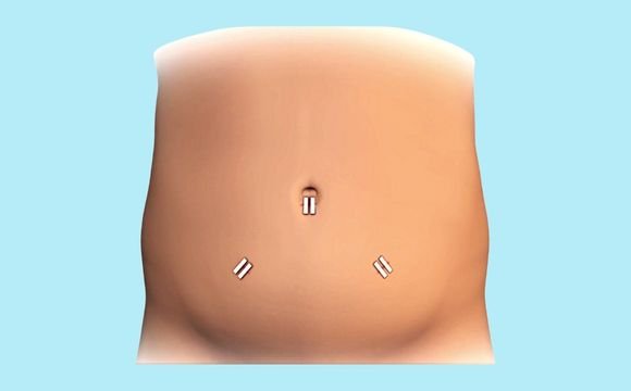 Recovery and Aftercare for Hernia Surgery