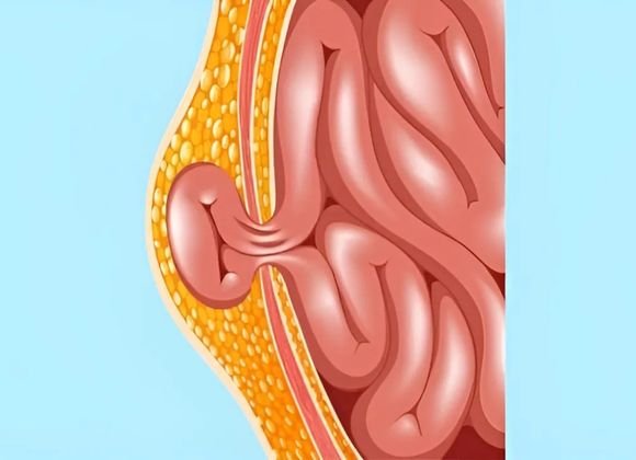 Hernia