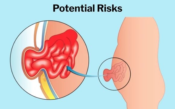 Potential Risks and Complications	of hernia