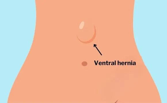 Symptoms of Ventral hernia