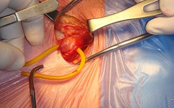  Laparoscopic Hernia Surgery