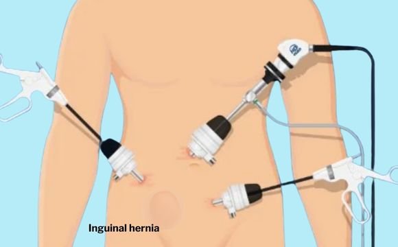 Benefits of Laparoscopic hernia treatment