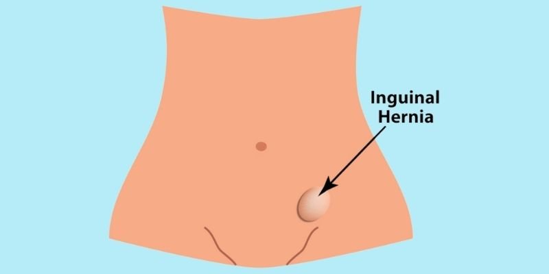 Laparoscopic Inguinal  Hernia Surgery Banner