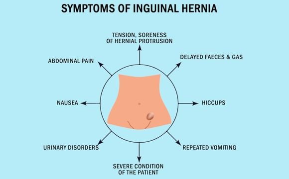 Symptoms of Inguinal hernia
