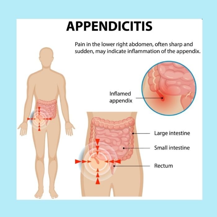 What is Appendicitis?