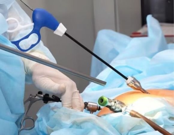 What is Laparoscopic Surgery