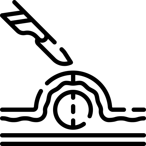 Pilonidal Sinus