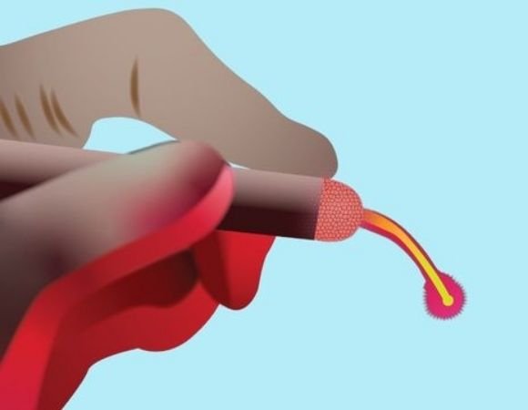 Laser surgery as a treatment