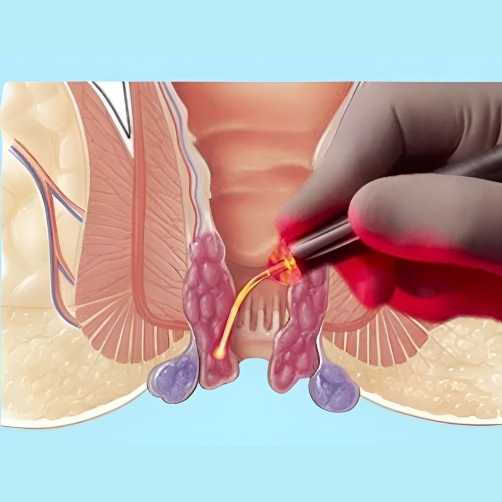 laser piles surgery