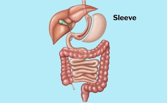 Sleeve Gastrectomy