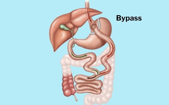 Gastric Bypass Surgery