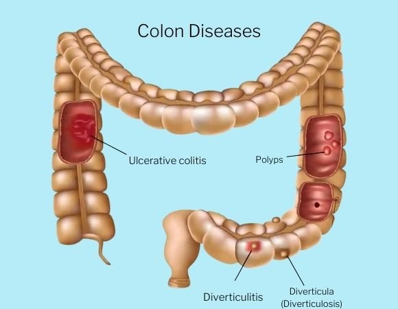 Conditions treated Colorectal Surgery