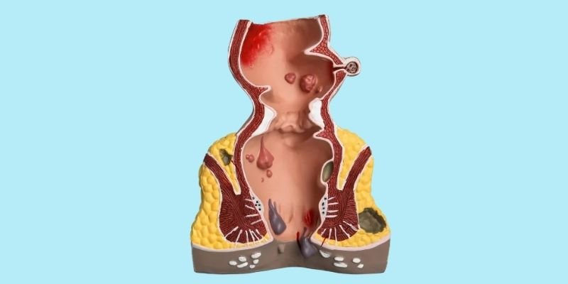 Laser Surgery for Hemorrhoids or Piles