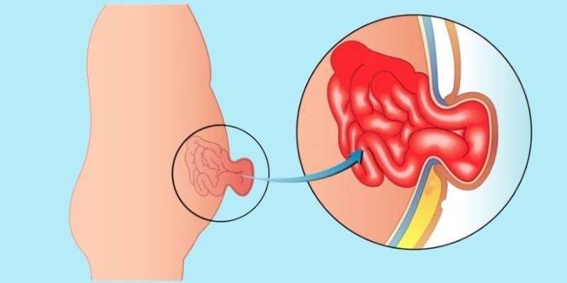 Laparoscopic Hernia Surgery Banner