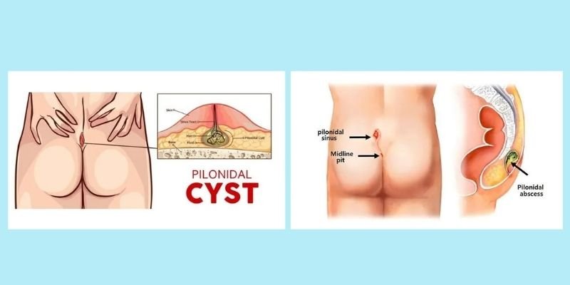 Laser Surgery for Anal Fissure & Pilonidal Sinus