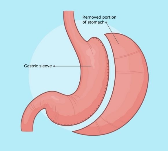 Sleeve Gastrectomy