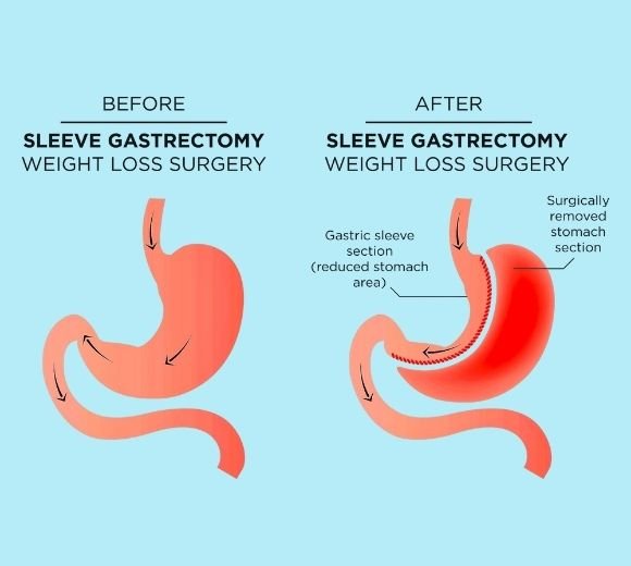 Benefits of Sleeve Gastrectomy