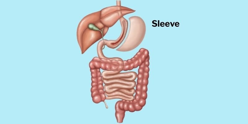 Sleeve Gastrectomy