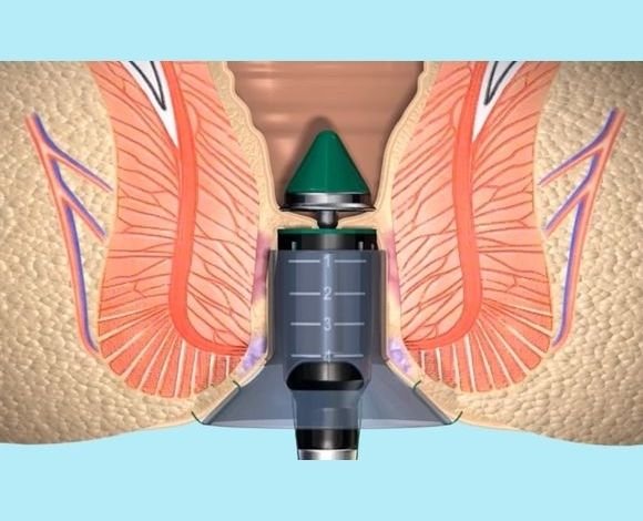 Risks & Complications for stapler surgery